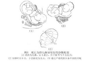 持續性枕後位難產