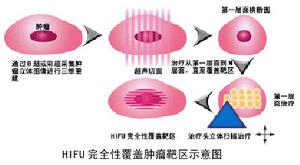 高強度聚焦超聲腫瘤治療系統