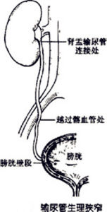 尿結石