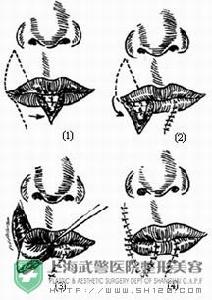 唇缺損修復術