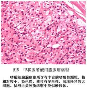 （圖）甲狀腺腺瘤