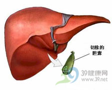 急性結石性膽囊炎