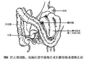 胃切除術後內疝 圖6