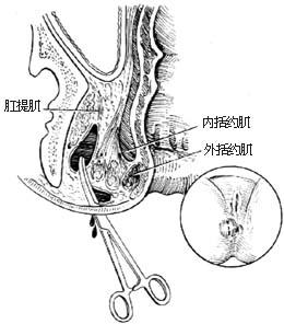 腸間膿腫