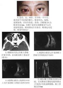 頸動脈海綿竇瘺