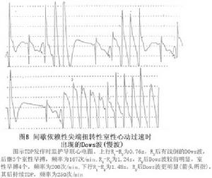 間歇依賴型尖端扭轉型室性心動過速