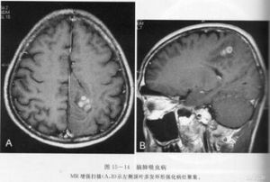 腦肺吸蟲病