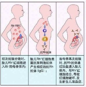 新生兒溶血