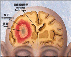 （圖）惡性腦膜瘤