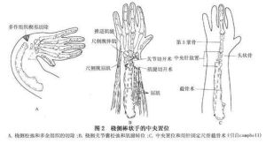 橈骨缺如