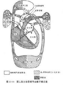 不典型主動脈縮窄症