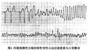 間歇依賴型尖端扭轉型室性心動過速