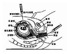 絨毛檢查相關圖片