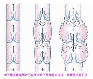 FOAM美國超聲納米導融術