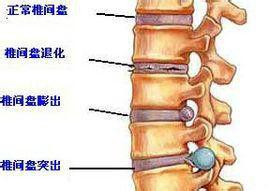 腰椎間盤退變