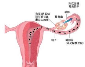 陳舊性宮外孕