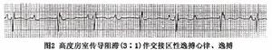 高度房室傳導阻滯