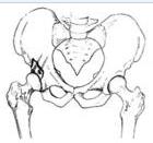 髖關節脫位切開復位術