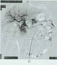 急性腸系膜上動脈梗死