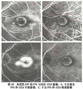 增齡性黃斑變性