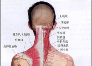 環枕筋膜攣縮型頸椎病