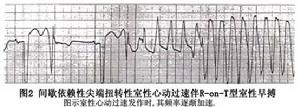 間歇依賴型尖端扭轉型室性心動過速