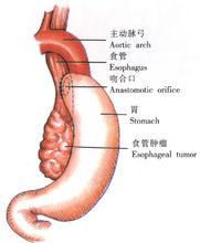 示意圖15:食管-胃底側側吻合
