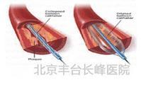 超聲微創介導