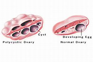 多囊卵巢綜合徵
