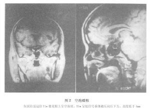 空鞍綜合徵