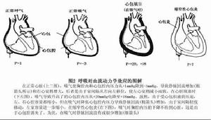 慢性縮窄性心包炎