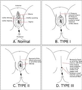 女性生殖器切割