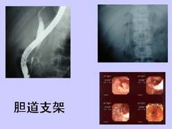 膽囊壁良性腫瘤