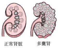 腎前性腎功能衰竭