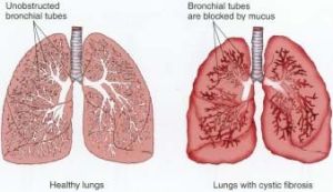 囊性纖維化