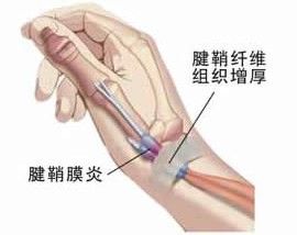 手腕損傷性腱鞘炎