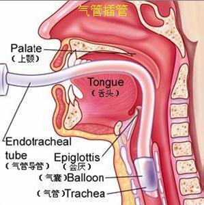 氣管插管術