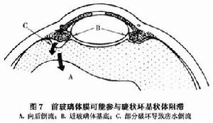 睫狀環阻滯性青光眼