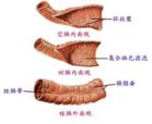 中毒型痢疾