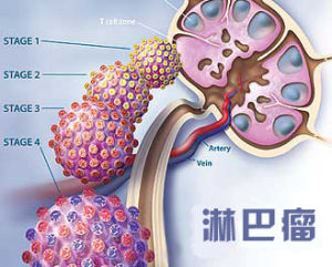 淋巴腺癌