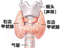 喬本氏甲狀腺炎