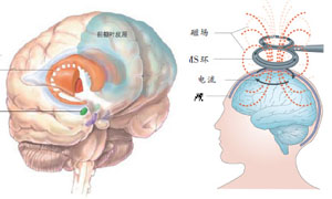 R-經顱電的治療原理 