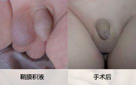 鞘膜積液手術