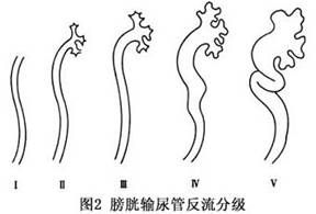 小兒原發性膀胱輸尿管反流