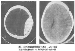 急性硬腦膜外血腫