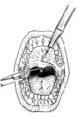 急性腺樣體炎