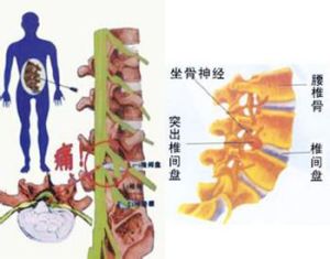 腰椎間盤