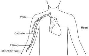 經外周靜脈穿刺中心靜脈置管圖