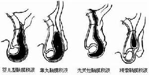 鞘膜積液