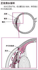 開角型青光眼